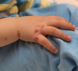 מחלת הפה והגפיים בקרב ילדים-תמונה